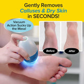 Electric Callus Remover with Built-in Vacuum